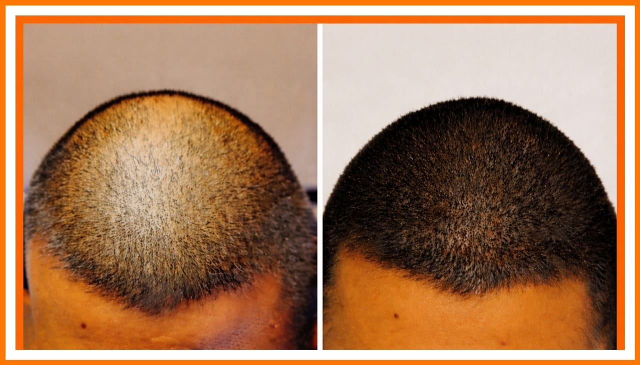 Scalp Micropigmentation Image
