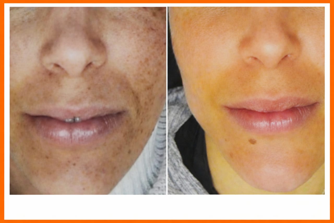 Chemical Peel Treatment