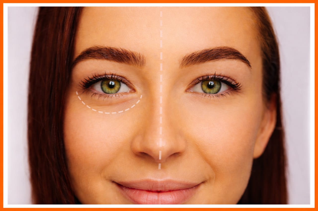 Dermal Fillers