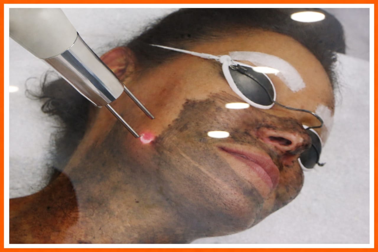 Laser Toning Treatment
