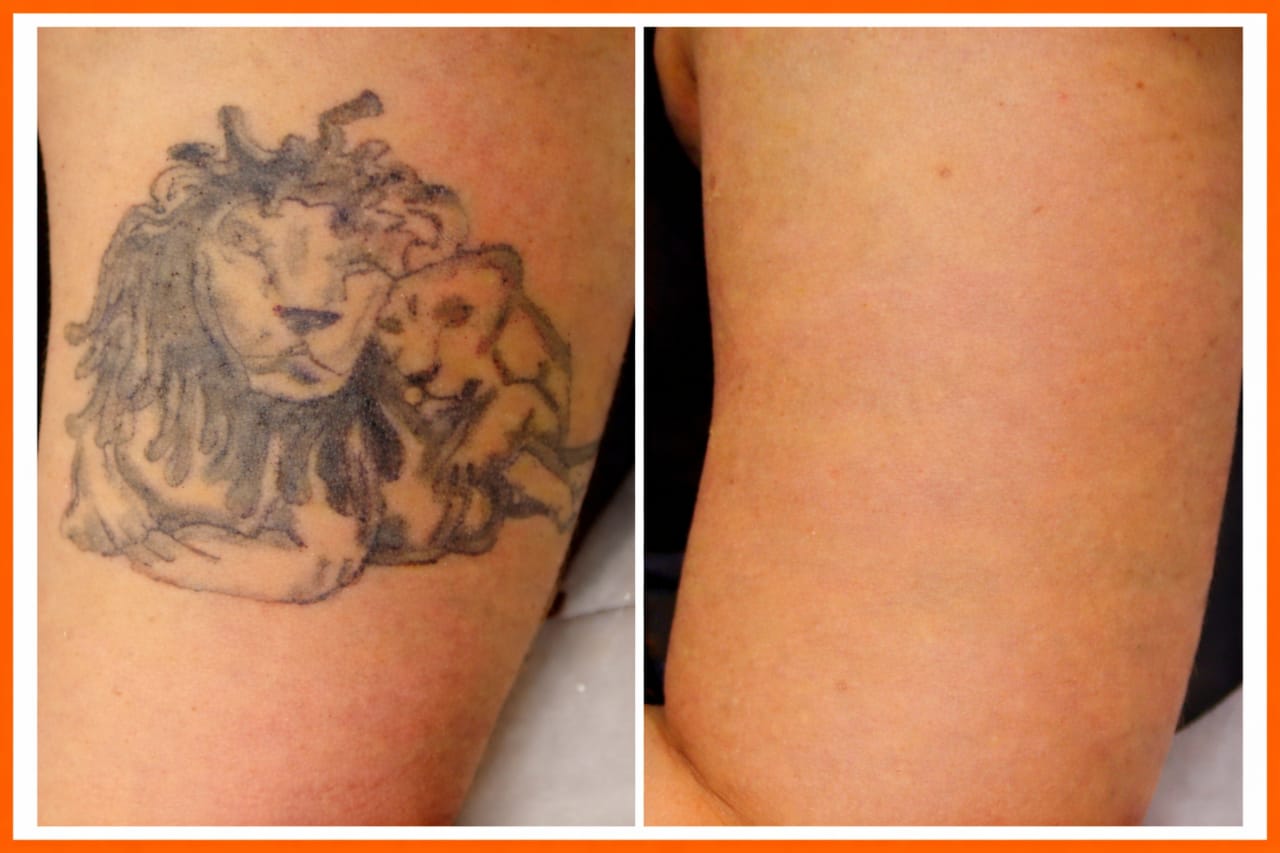 Tattoo Removal Laser Image